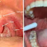 Code Pen posterior oropharyngeal erythema