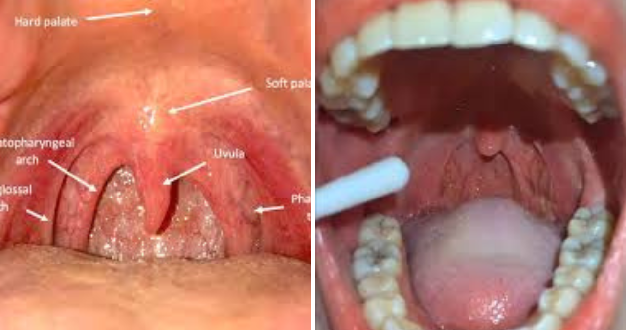 posterior oropharyngeal erythema