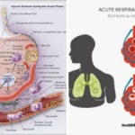 Hypoxemic Respiratory Failure