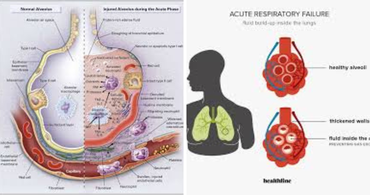 Hypoxemic Respiratory Failure